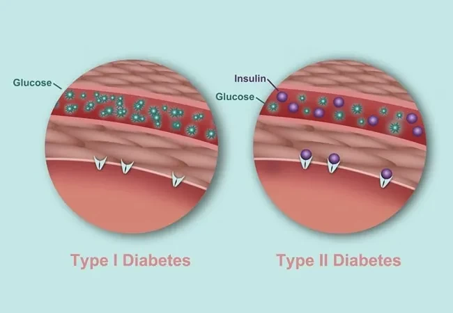 Understanding the Different Types of Diabetes