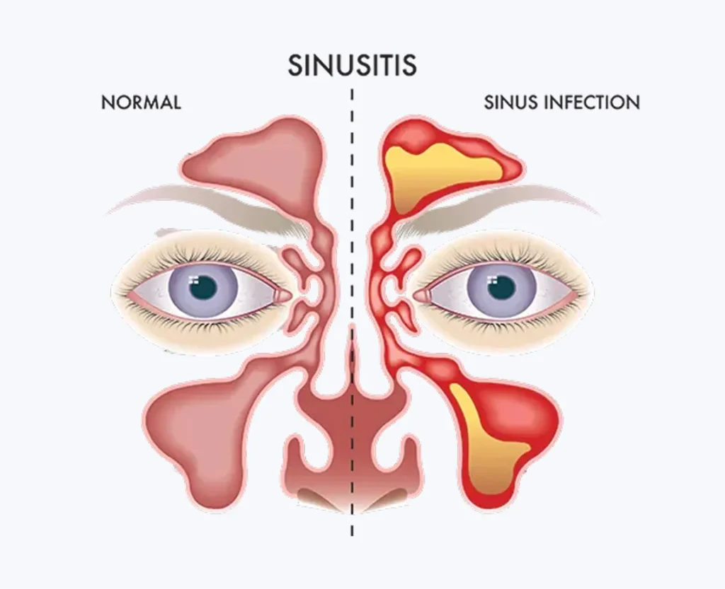 Acute vs. Chronic Sinusitis
