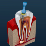 Can root canals cause cancer