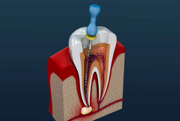 Can root canals cause cancer