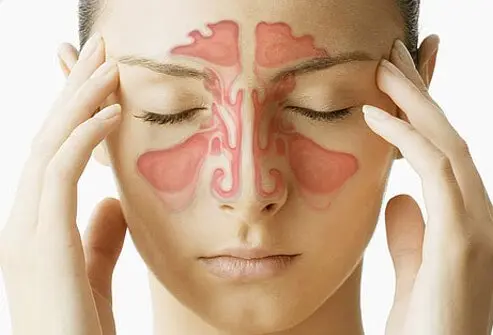 Common Signs of a Sinus Infection