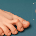 How Long Does a Fractured Toe Take to Heal