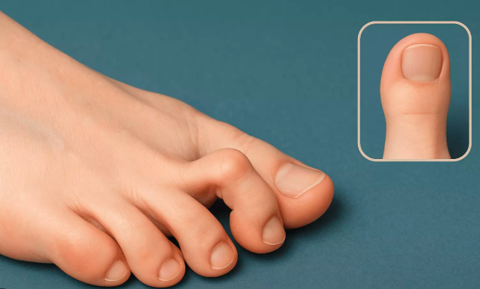 How Long Does a Fractured Toe Take to Heal