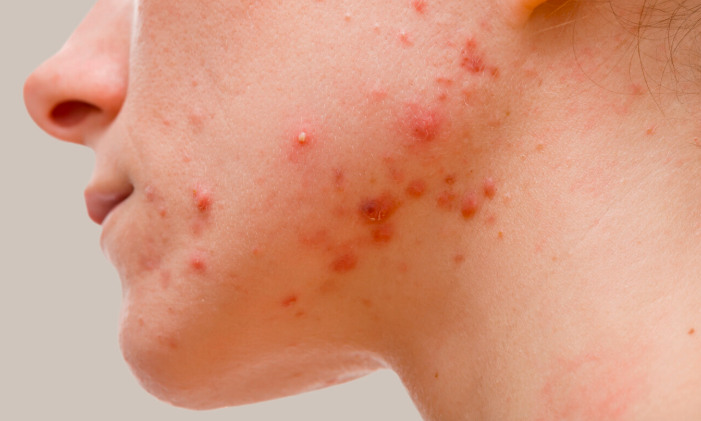 How to Treat Jawline Acne Naturally