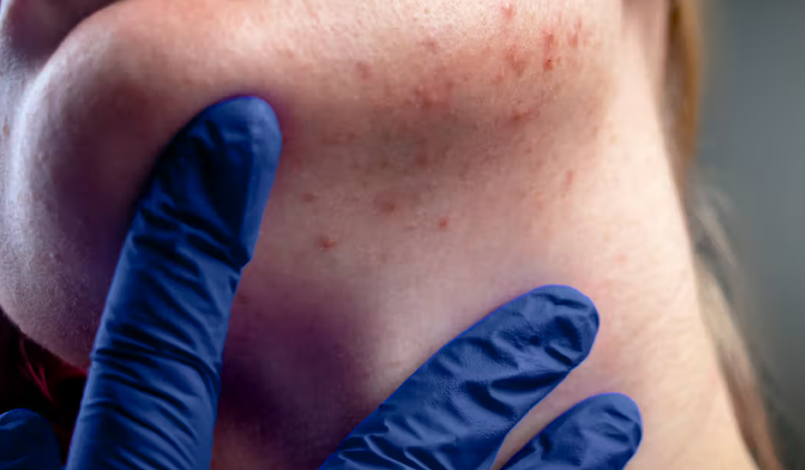 Jawline Acne