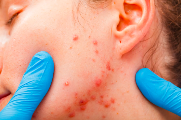 Signs and Symptoms of Jawline Acne