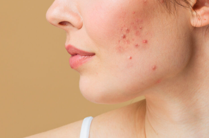 Tips to Prevent Jawline Acne in the Future