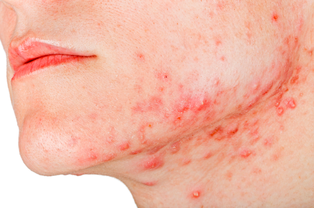 What Is Jawline Acne?