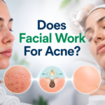 Does Facial Work for Acne