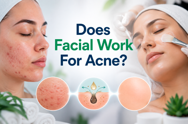 Does Facial Work for Acne