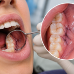 How Long Do Dissolvable Stitches Last in Mouth