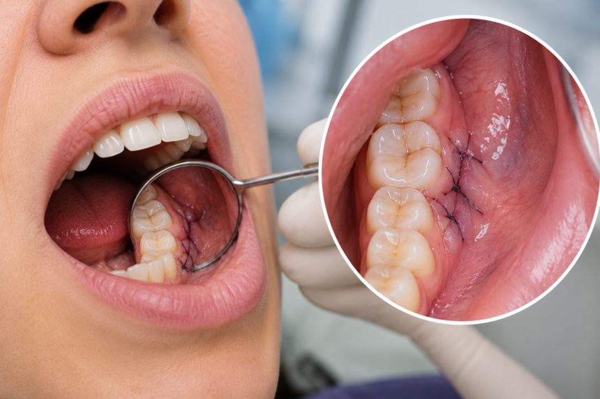 How Long Do Dissolvable Stitches Last in Mouth