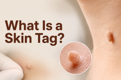 What Is a Skin Tag?