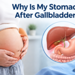 Why Is My Stomach Bigger After Gallbladder Surgery?